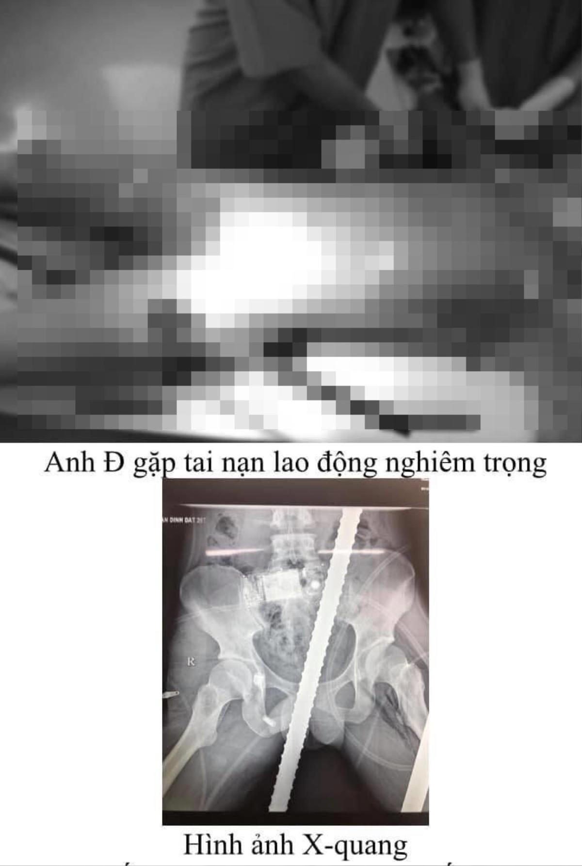 Cứu sống nam thanh niên bị hai thanh sắt xuyên qua người trong tình trạng sốc đa chấn thương Ảnh 1