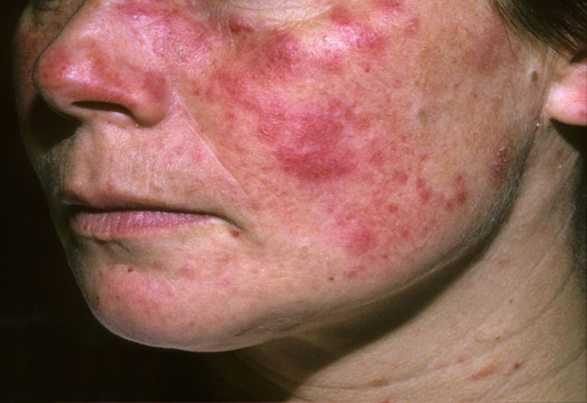 Căn bệnh lupus ban đỏ diễn viên Châu Hải My từng mắc phải trước khi qua đời nguy hiểm thế nào? Ảnh 2