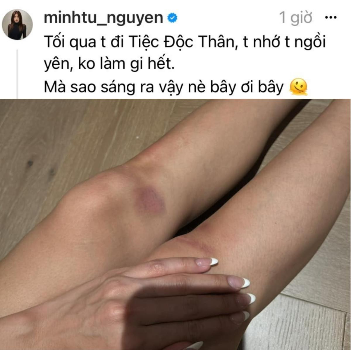 Một nữ siêu mẫu bị thương sau khi tham gia tiệc độc thân của hoa hậu Khánh Vân Ảnh 1