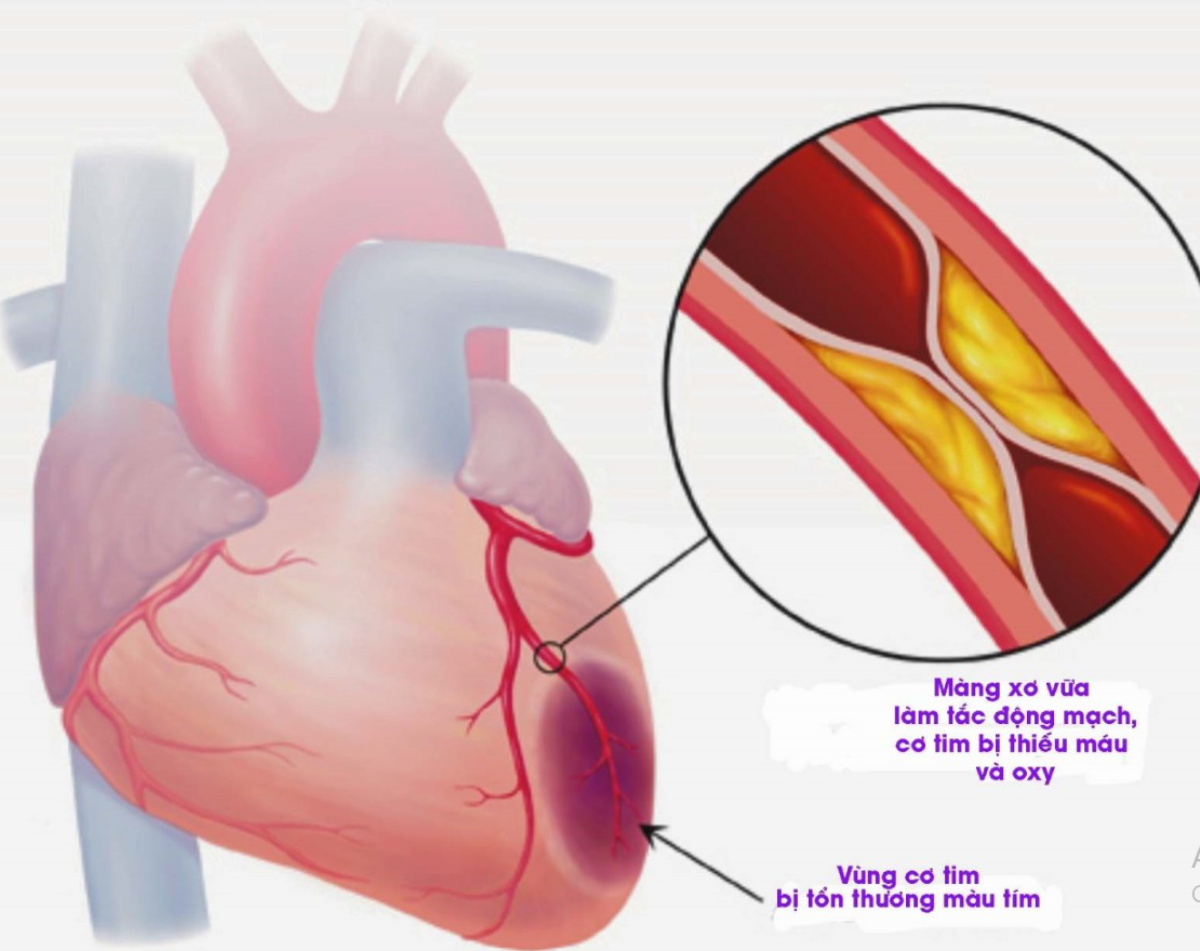 Căn bệnh khiến diễn viên Đức Tiến đột ngột ra đi vô cùng nguy hiểm Ảnh 3