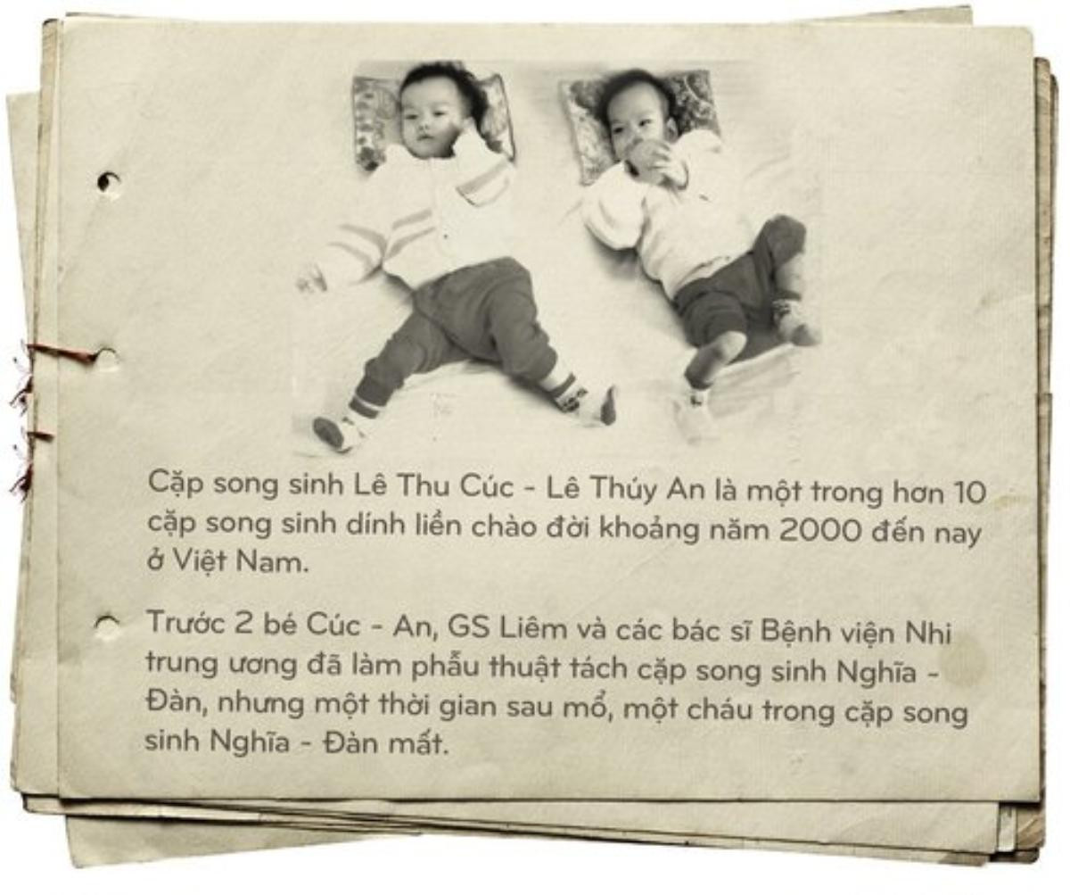 Nhìn lại 8 ca song sinh dính liền được phẫu thuật tách rời thành công ở Việt Nam Ảnh 5