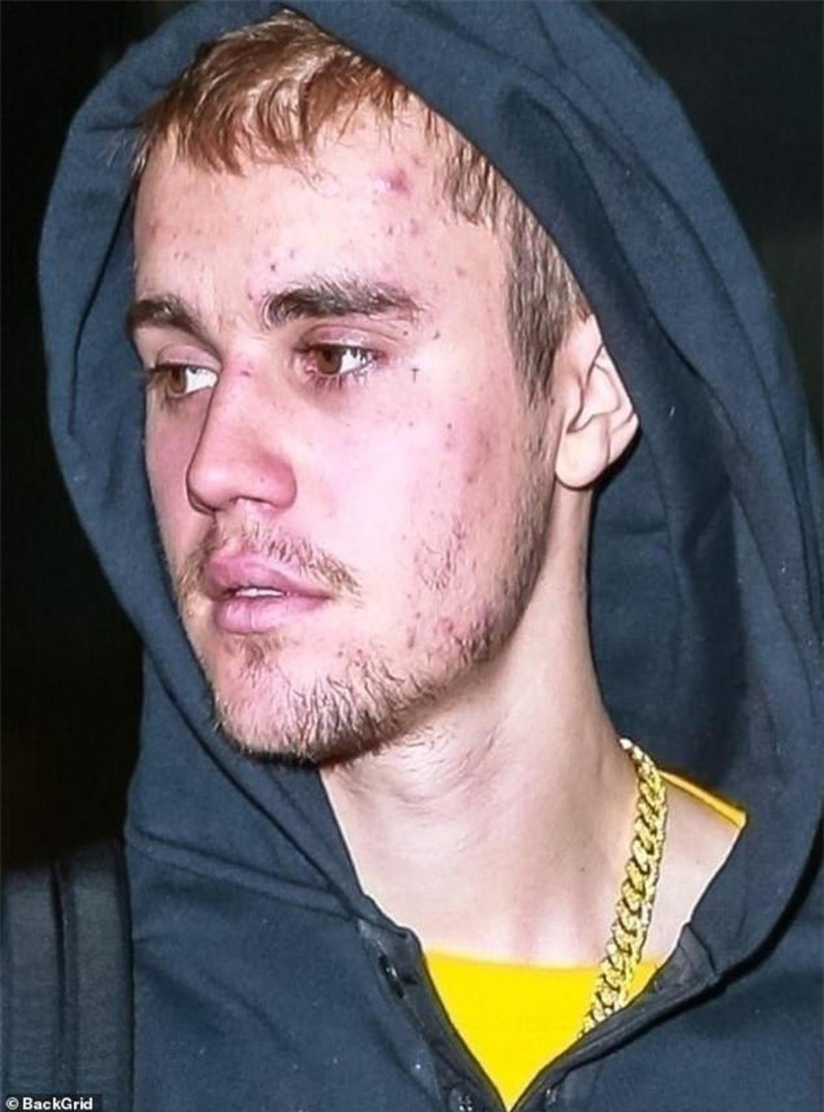 Justin Bieber khoe làn da căng bóng, khỏe mạnh nhờ được Hailey điều trị mụn trong thời gian cách ly Ảnh 6