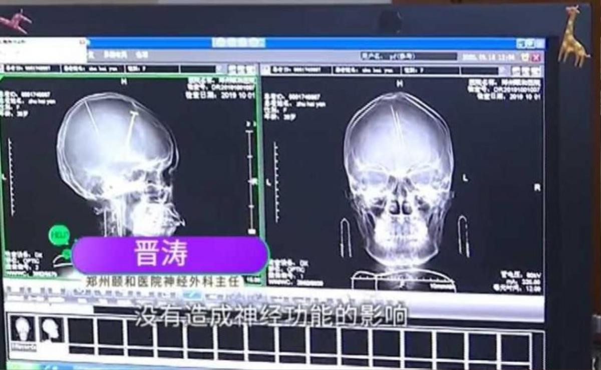 Đi chụp CT sau tai nạn xe, người phụ nữ bất ngờ phát hiện hai cây kim dài đâm sâu vào não Ảnh 1