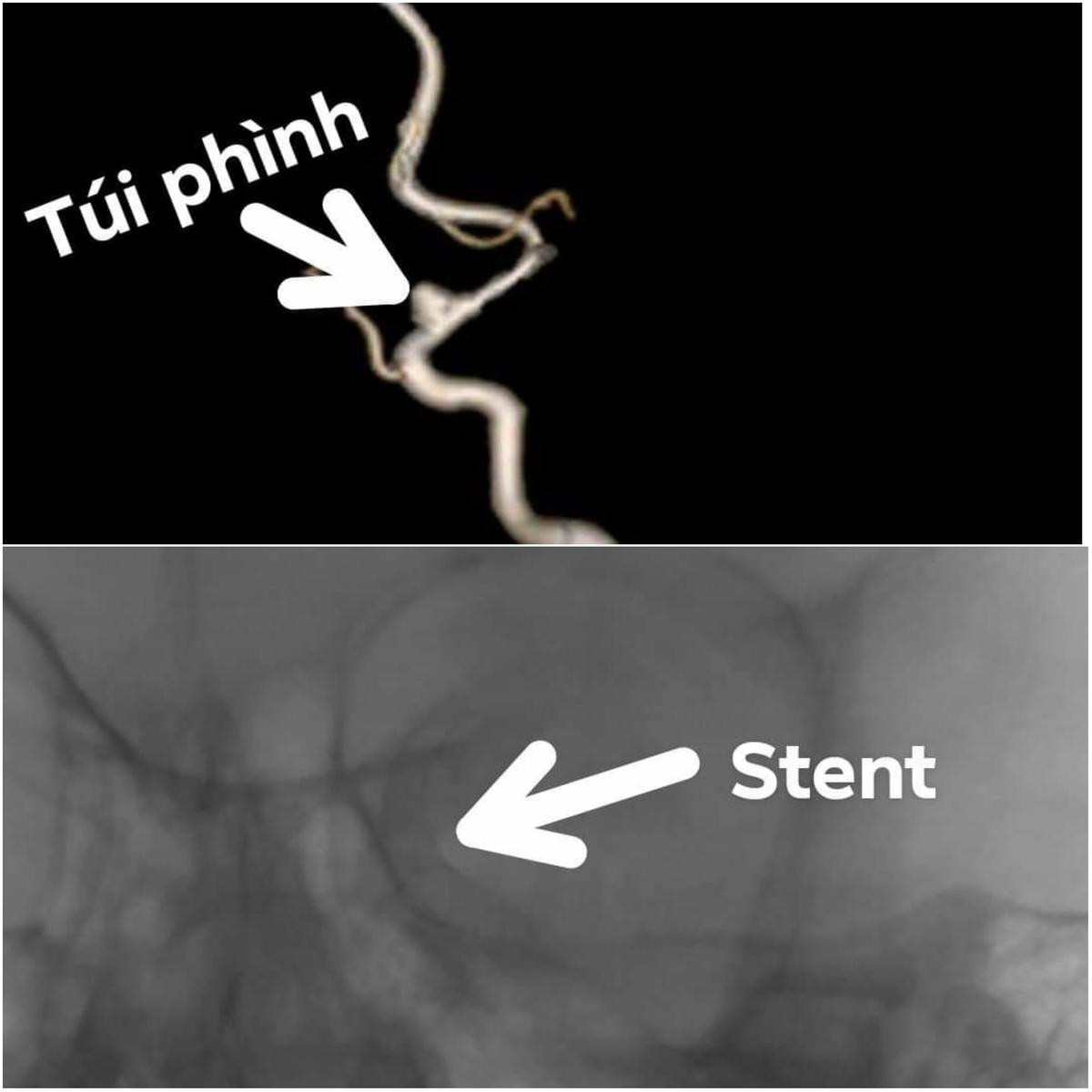 Cứu sống thành công bé trai 3 tuổi bị đột quỵ trong lúc đang chơi với bạn Ảnh 2