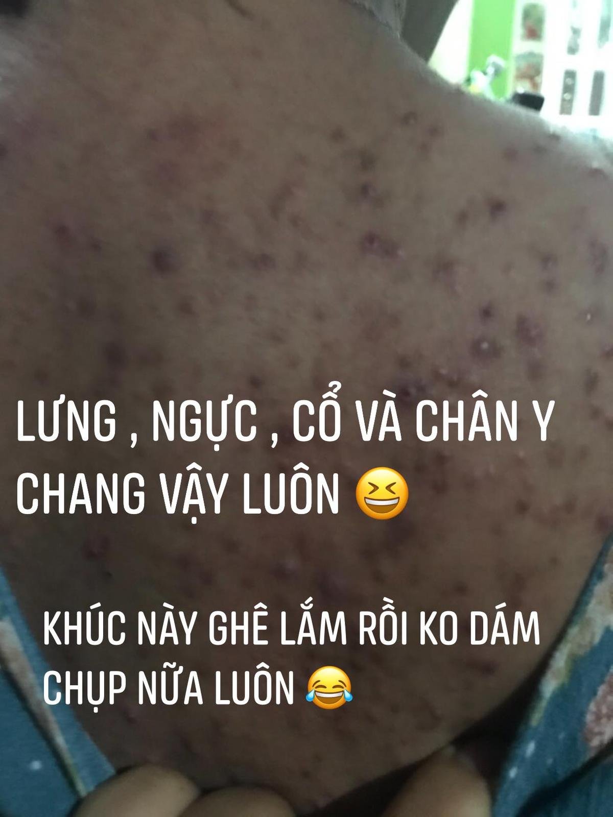 Hoa hậu Đại dương Đặng Thu Thảo khiến dân tình 'phát hoảng' với gương mặt mọc đầy mụn Ảnh 4