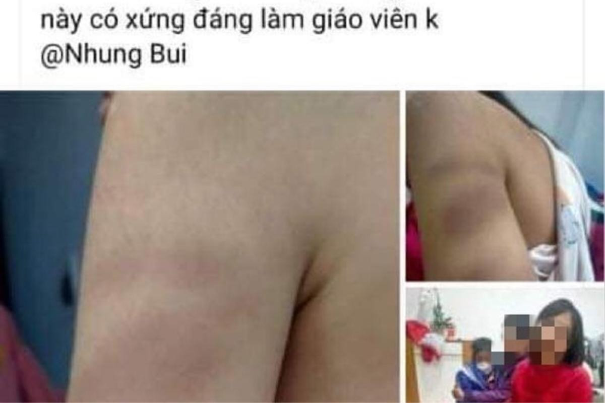 Dùng thước đánh tím tay học sinh lớp 1, cô giáo ở Hải Phòng bị đình chỉ dạy học một tuần Ảnh 1