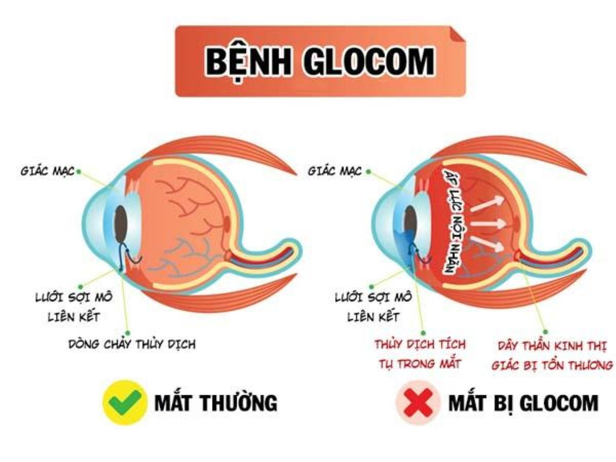 Bệnh Glôcôm gây mù lòa không hồi phục: Hãy cứu lấy thị giác của bạn! Ảnh 1