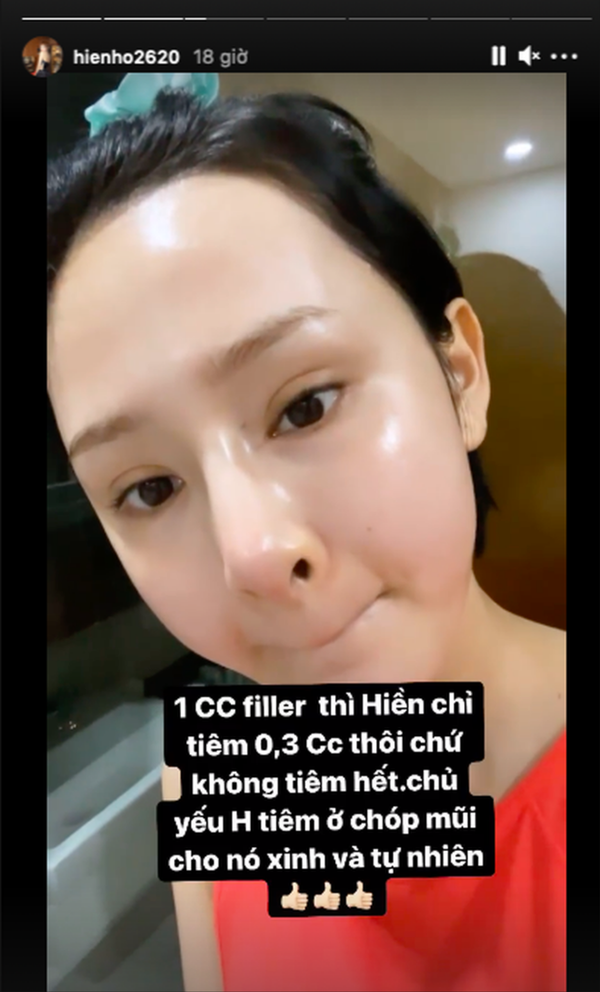 Hiền Hồ mê tiêm má baby, thêm filler mũi... kết quả cuối cùng đơ cứng như tượng sáp Ảnh 4