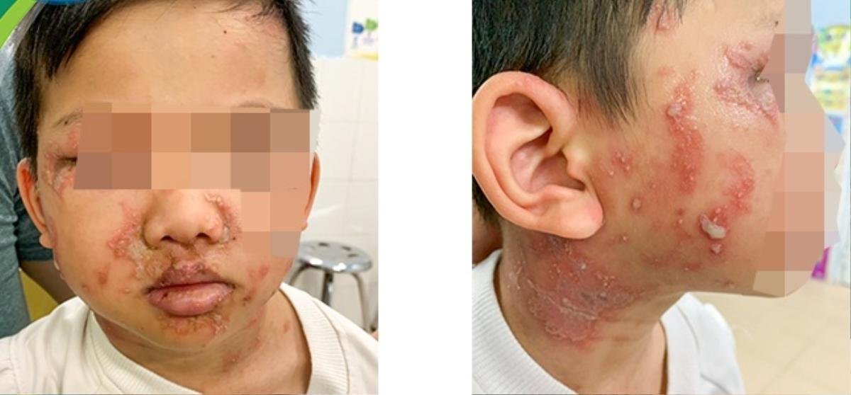 Gia đình và cuộc 'đại chiến' với kiến ba khoang: 'Khi nào cần đưa con trẻ đi khám?' Ảnh 2