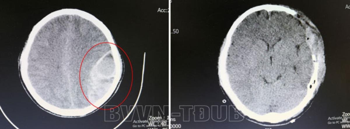 Sau chấn thương vùng đầu, thanh niên chủ quan không đi khám liền rơi vào hôn mê sâu Ảnh 1