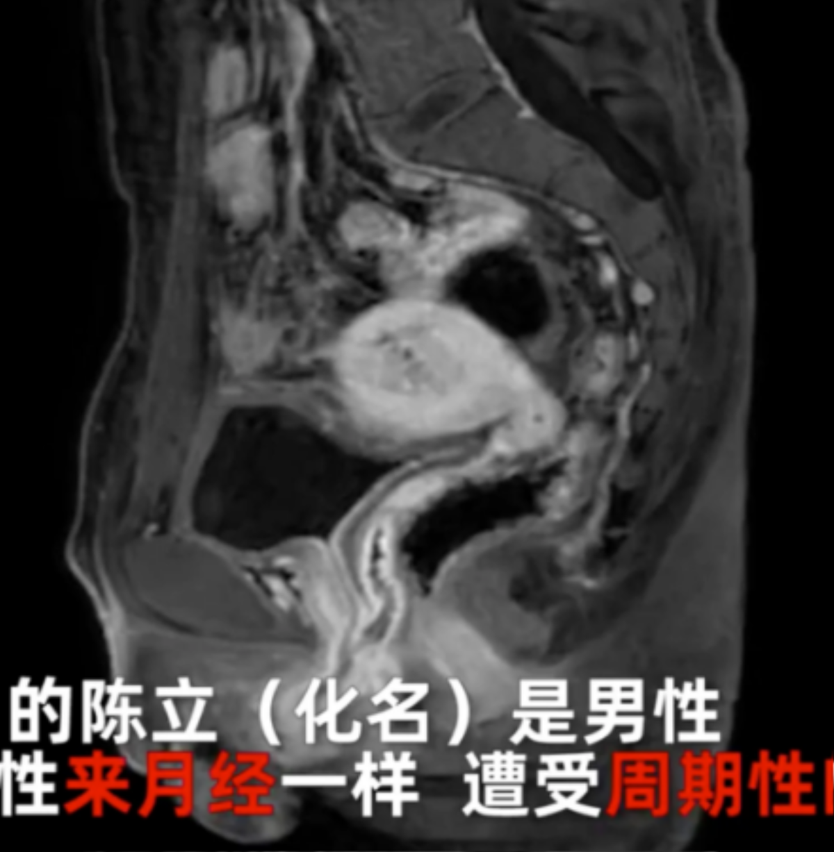 Người đàn ông bị sốc khi biết mình có buồng trứng, tử cung và kinh nguyệt hàng tháng Ảnh 1