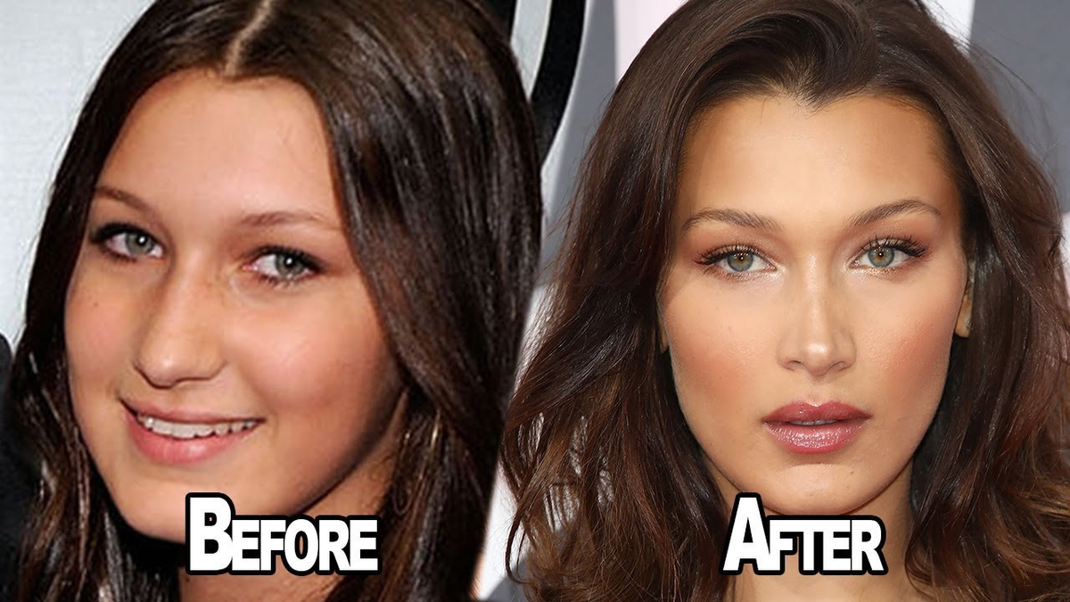 Bella Hadid từng hối hận vì 'dao kéo' Ảnh 1