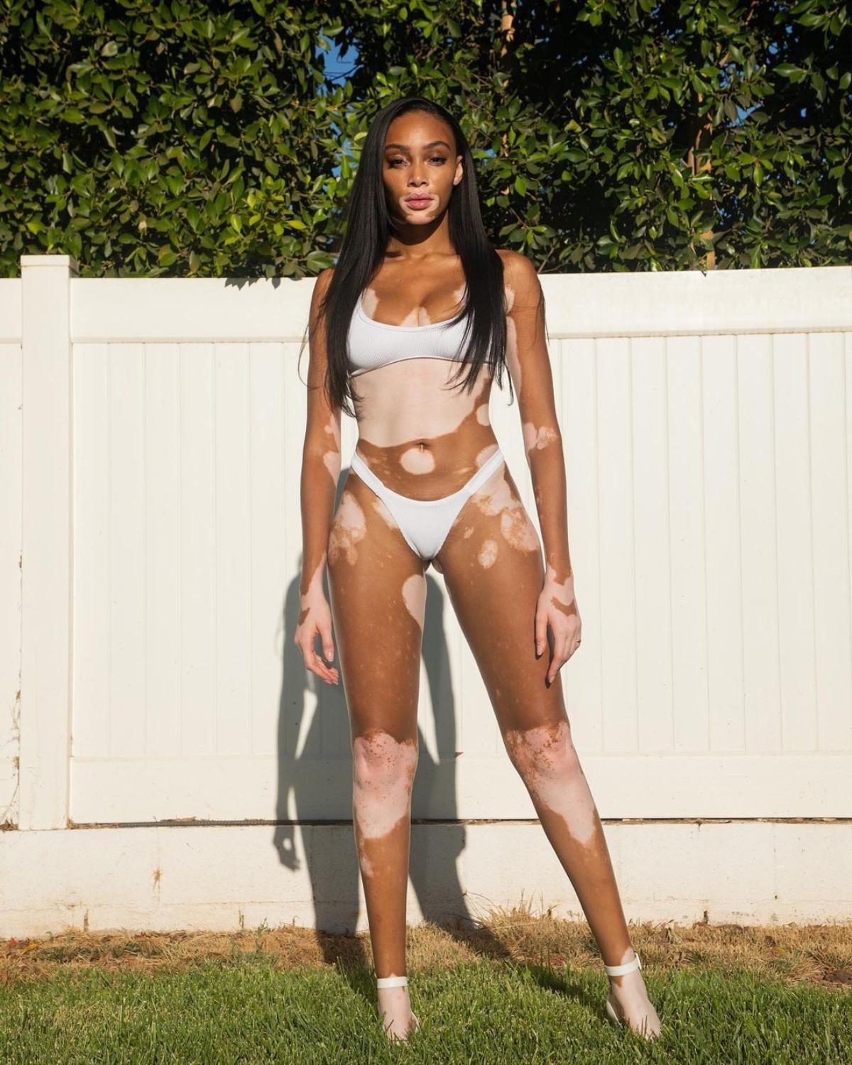 Winnie Harlow: siêu mẫu mắc bệnh bạch biến phá vỡ định kiến lỗi thời về tiêu chuẩn sắc đẹp Ảnh 5