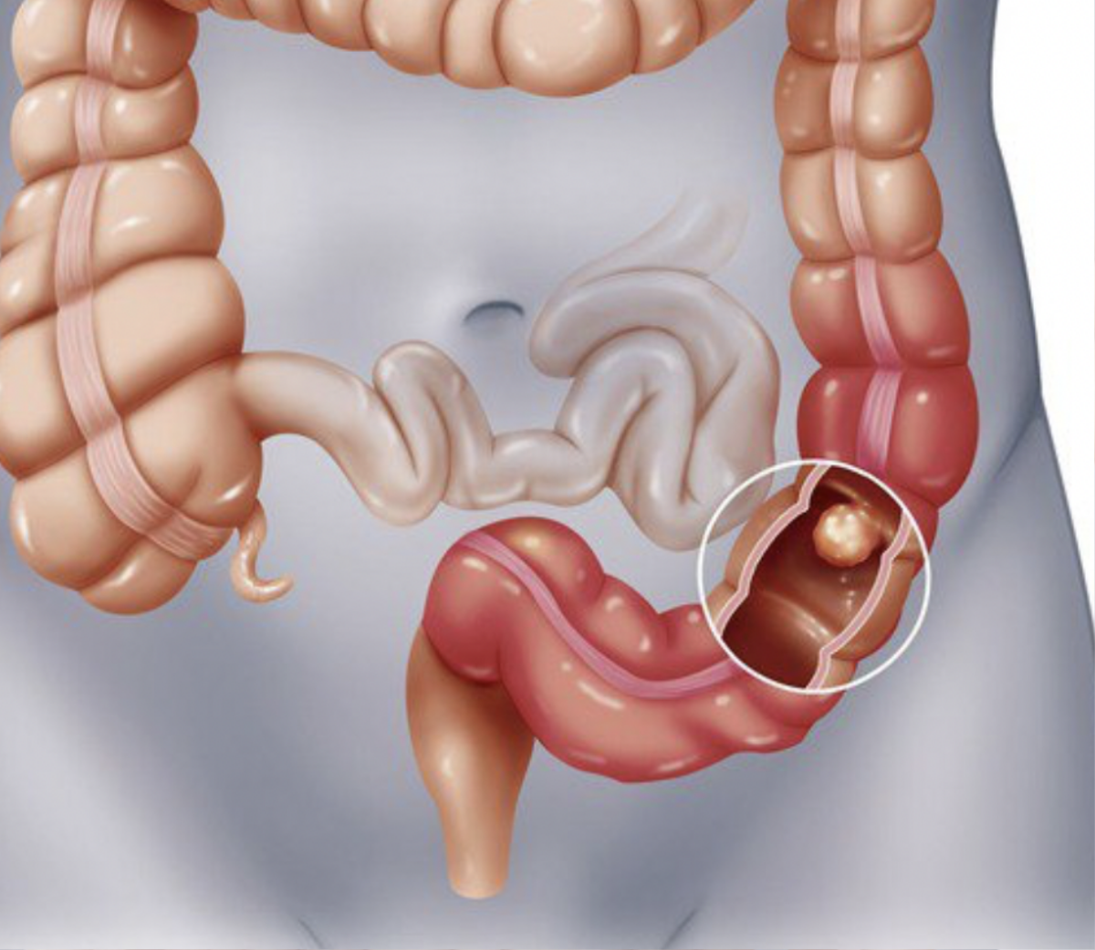 Căn bệnh NSƯT Vũ Linh đối mặt những năm tháng cuối đời nguy hiểm thế nào? Ảnh 1