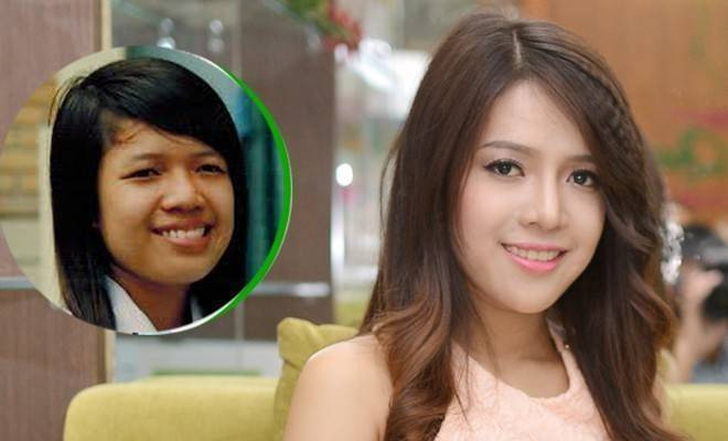 Khắc phục khuyết điểm hô móm sau một lần phẫu thuật Ảnh 2