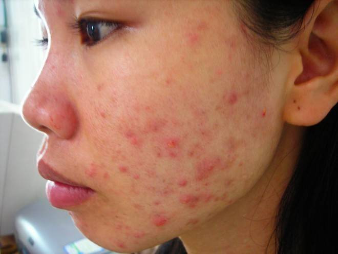 Dẹp bỏ nỗi khổ bệnh da mùa hè Ảnh 2