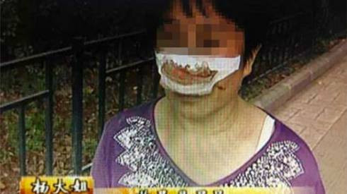 Bị chồng cắn đứt lìa mũi vì không nghe điện thoại Ảnh 2