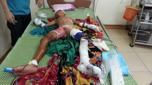 Đồ chơi phát nổ: bé trai bị dập bàn tay, đứt động mạch đùi Ảnh 2