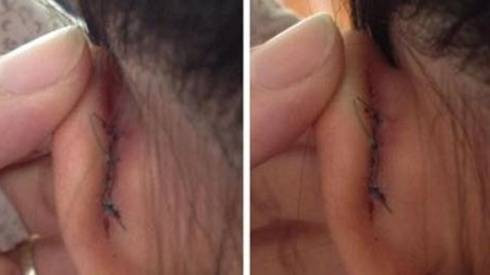 Học sinh bị cô giáo véo đứt tai vì viết chậm Ảnh 2