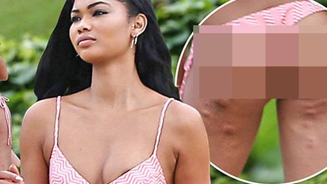 ‘Thiên thần nội y’ lộ vết mẩn ngứa khi mặc bikini Ảnh 2