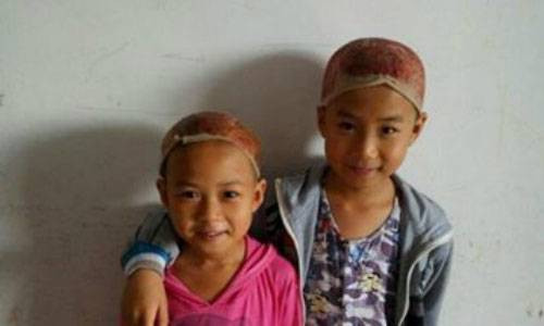 Hai em bé chịu đau, hiến da đầu cứu cha Ảnh 2