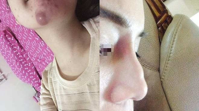 Tràn lan mốt làm đẹp tiêm Filler và hiểm họa khi tiêm phải chất dởm Ảnh 2