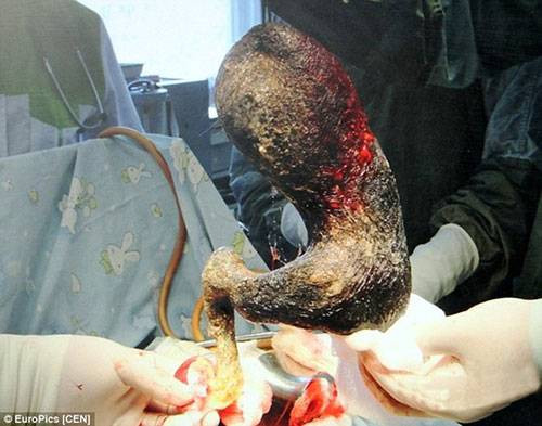 Phát hiện cuộn tóc rối to 10 cm trong bụng bé gái 7 tuổi Ảnh 2