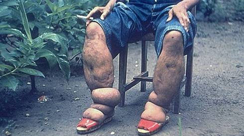 Những căn bệnh khủng khiếp rình rập khách du lịch Ảnh 2