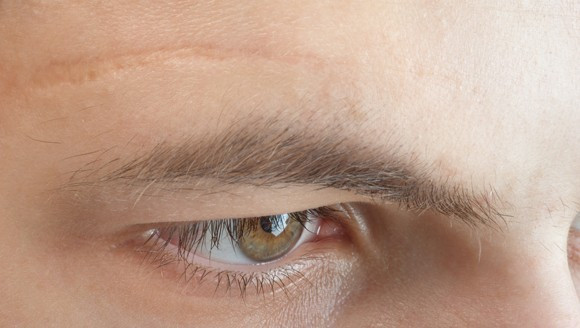 3 vị trí sẹo không nên xuất hiện trên mặt Ảnh 2