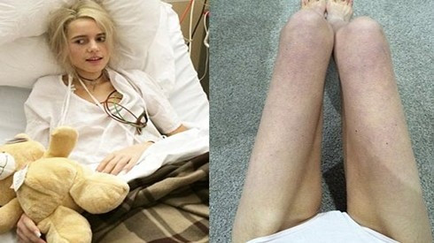 Cô gái 19 tuổi suýt chết vì nhịn ăn để giảm cân Ảnh 2