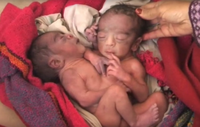 Vợ chồng trẻ giành giật sự sống cho cặp song sinh 2 đầu, 4 tay, 2 chân Ảnh 2