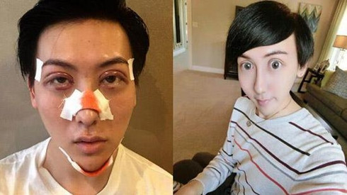 5 biến chứng phẫu thuật thẩm mỹ đáng sợ nhất năm 2015 Ảnh 2