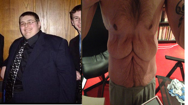 Hậu quả bất ngờ của việc giảm cân nhanh hơn 100 kg của chàng béo Ảnh 2