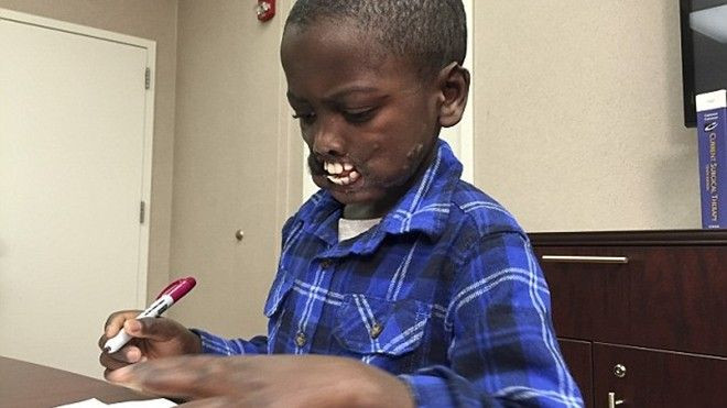 Xót xa bé trai 8 tuổi bị biến dạng mặt vì tinh tinh hoang tấn công Ảnh 2