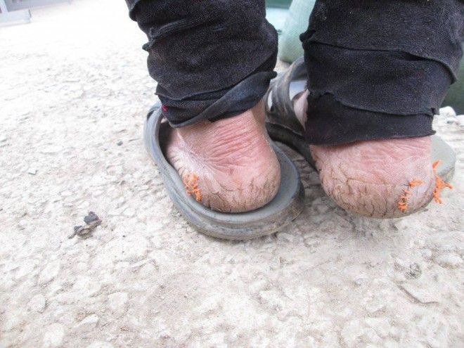 Đau lòng hình ảnh gót chân nứt nẻ phải khâu bằng chỉ của phụ nữ Tây Bắc Ảnh 2