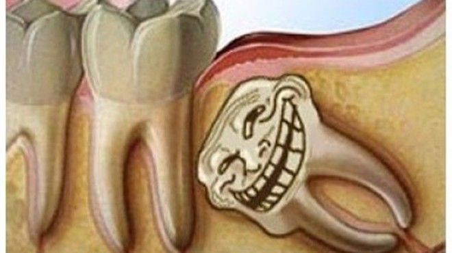 Cận cảnh quá trình xử lý răng khôn gây… đứng hình Ảnh 2