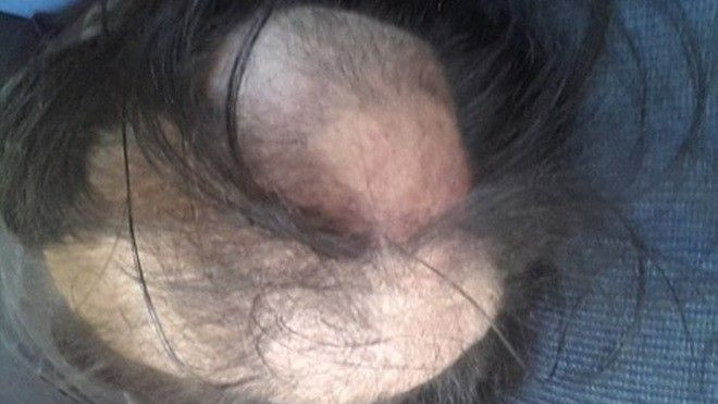 Thói quen xấu khiến nữ sinh 21 tuổi bỗng dưng… trọc đầu Ảnh 2