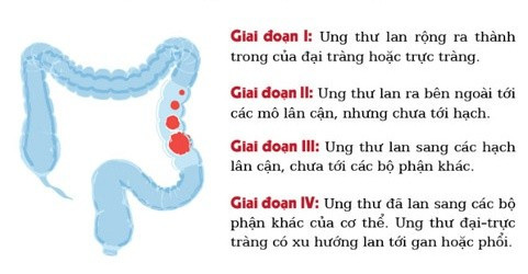 [Infographic] Điều cần biết về căn bệnh ung thư trực tràng Ảnh 2
