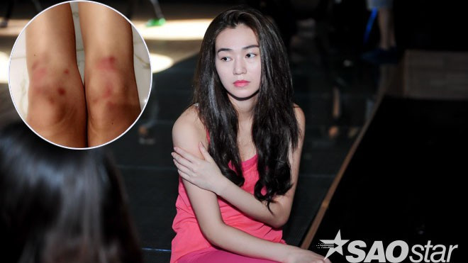 Fan xót xa vì hình ảnh đôi chân bầm tím của Khánh My Ảnh 2