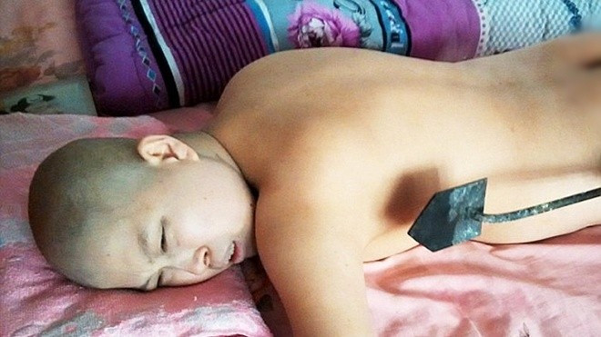 Ám ảnh ung thư, cô gái trẻ dí sắt nung vào người để chữa bệnh Ảnh 2