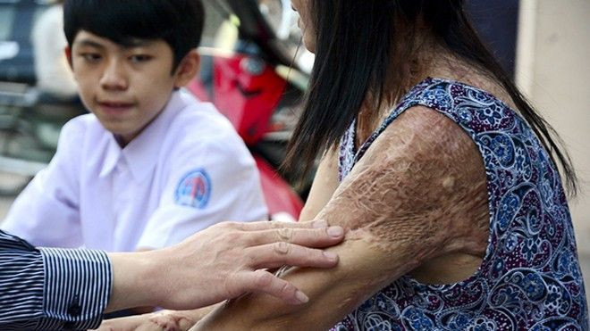 Nạn nhân bị tạt axit: ‘Kẻ ở tù rồi cũng có ngày ra, nạn nhân bị tạt axit đau khổ hơn chết’ Ảnh 2