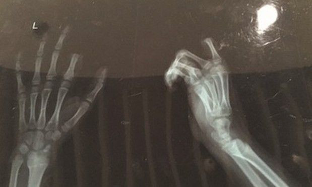 Bị mắng do sử dụng smartphone nhiều, bé trai tự cắt ngón tay Ảnh 2