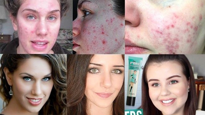 Không cần photoshop, mụn cỡ nào make-up cũng che được! Ảnh 2