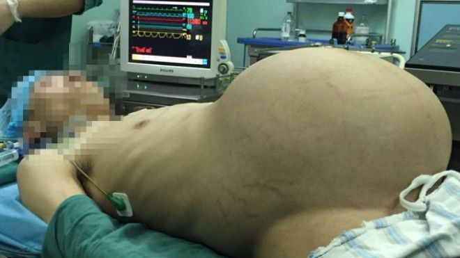Phát hoảng khối u 15kg của người đàn ông bụng 'bầu' sau ca phẫu thuật Ảnh 2