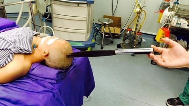 Bố chồng làm rơi dao nhọn giữa đỉnh đầu con dâu mang thai Ảnh 2