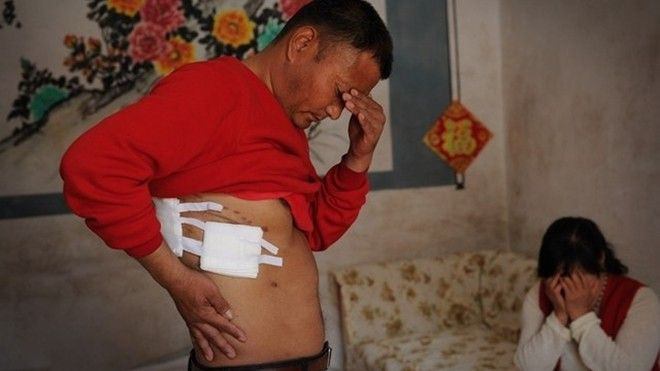 Hoảng hồn phát hiện mất một bên thận sau khi phẫu thuật ngực Ảnh 2