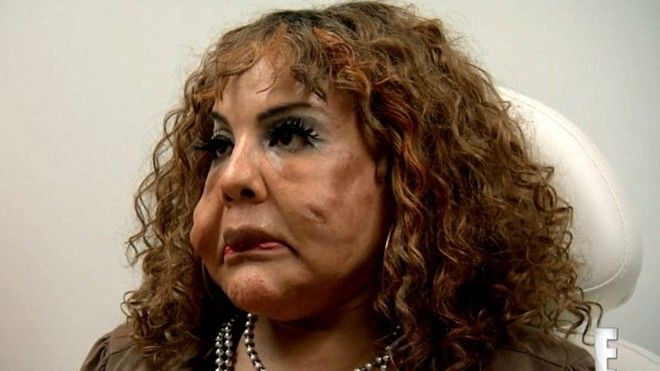 Khuôn mặt đóng đá vì tiêm hóa chất độc hại khi phẫu thuật thẩm mỹ “chợ đen” Ảnh 2