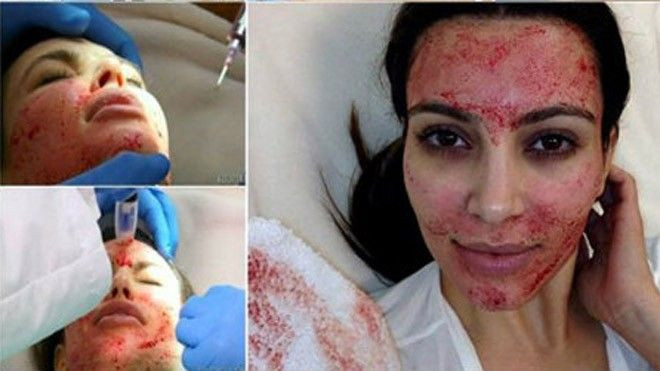 Phát hoảng vì những cách làm đẹp kinh dị của sao Ảnh 2