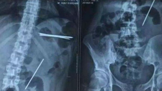 Cái kết đắng của màn thể hiện bản lĩnh 'ruột thép' trước mặt bạn gái Ảnh 2