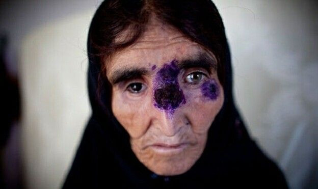 Vi khuẩn 'ăn thịt người' gieo rắc nỗi kinh hoàng cho nhân loại  Ảnh 2